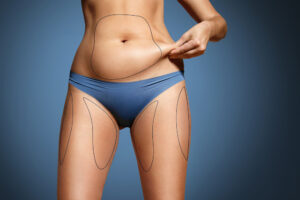 Good-Candidates-for-Liposuction-Dr.-Fichadia