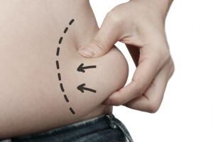 Liposuction-Benefits-Dr.-Fichadia