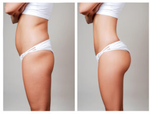 Liposuction-Recovery-Dr.-Fichadia