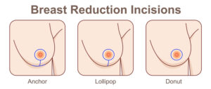 breast reduction incision types - dr. fichadia