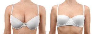 Final results of a breast reduction - Dr. Fichadia